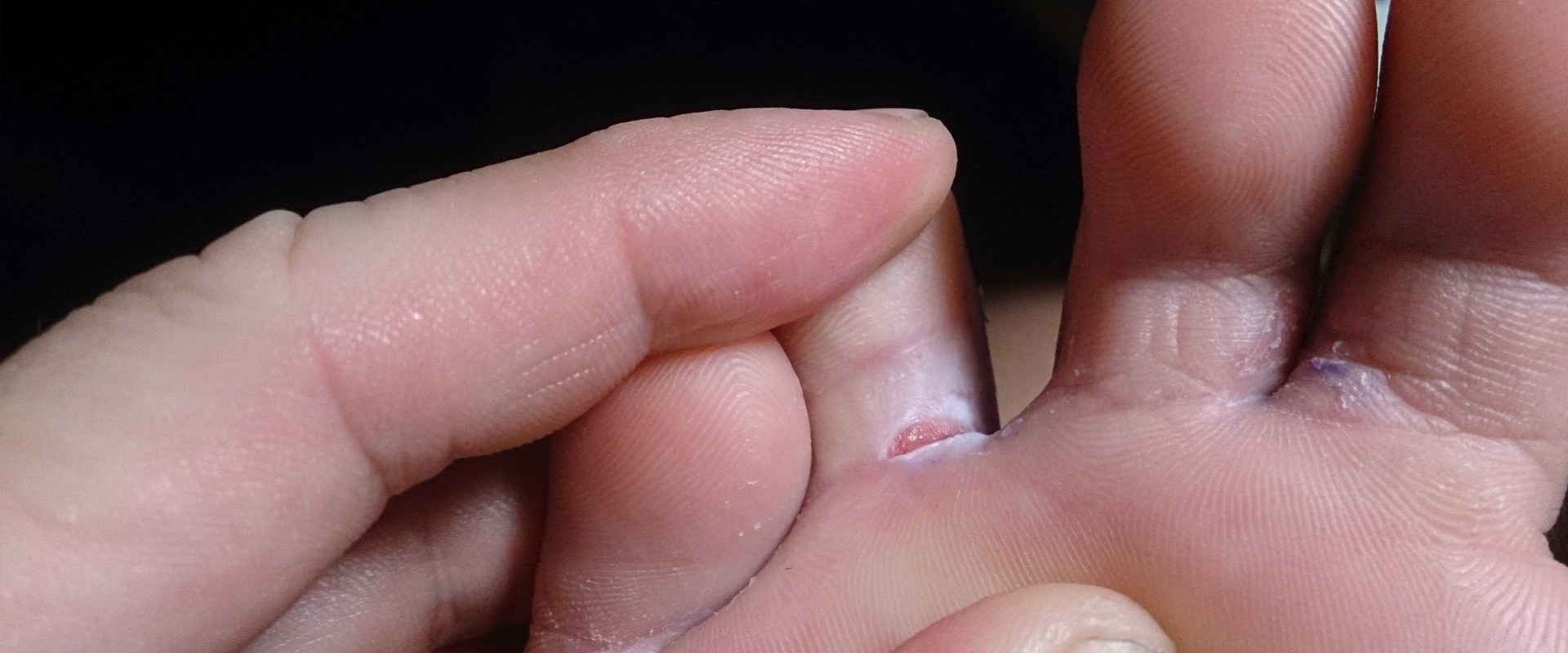 Burning, Cracked Skin? What Is Athlete's Foot Fungus Between the Toes and What to Do About It