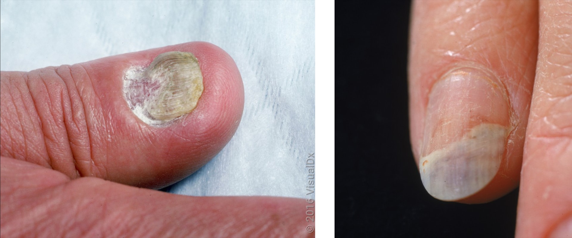 Nail Mold vs Fungus: Experts Reveal How to Stop the Spread Fast