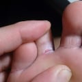 Burning, Cracked Skin? What Is Athlete's Foot Fungus Between the Toes and What to Do About It