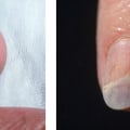 Nail Mold vs Fungus: Experts Reveal How to Stop the Spread Fast