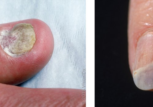 Nail Mold vs Fungus: Experts Reveal How to Stop the Spread Fast